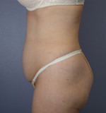 Tummy Tuck Before and after photo