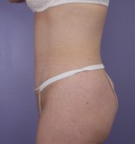 Tummy Tuck Before and after photo