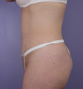 Tummy Tuck before and after photo