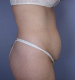 Tummy Tuck Before and after photo