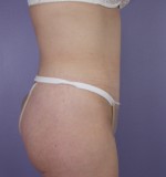 Tummy Tuck Before and after photo