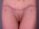 Labiaplasty