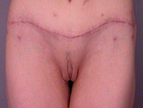 Labiaplasty before and after photo