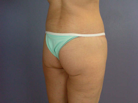 Body Lift before and after photo