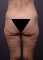 Posterior Lift Before and after photo