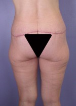 Posterior Lift Before and after photo