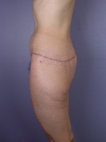 Posterior Lift Before and after photo