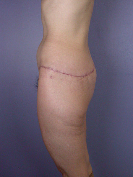 Posterior Lift before and after photo