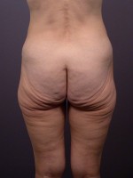 Posterior Lift Before and after photo