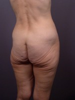 Posterior Lift Before and after photo