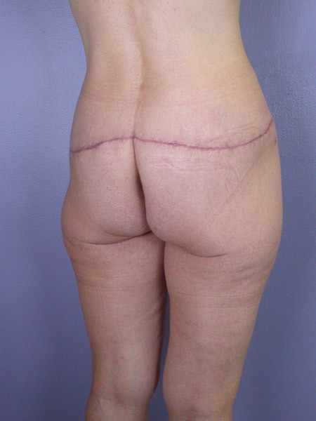Posterior Lift before and after photo