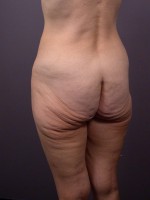 Posterior Lift Before and after photo