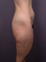 Posterior Lift Before and after photo