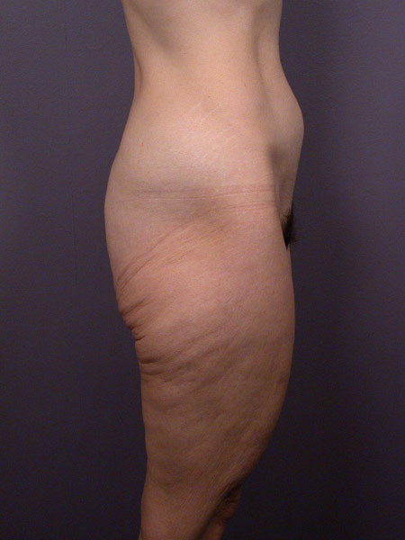 Posterior Lift before and after photo