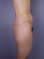 Posterior Lift Before and after photo