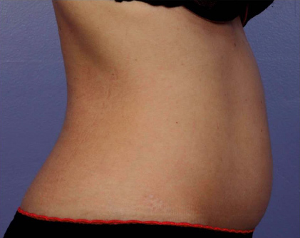 Liposonix® before and after photo