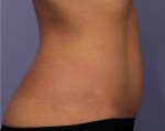 Liposonix® Before and after photo