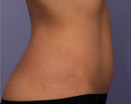 Liposonix® before and after photo