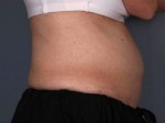 Liposonix® Before and after photo