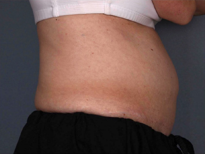 Liposonix® before and after photo