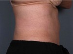 Liposonix® Before and after photo