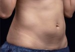 Liposonix® Before and after photo