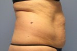 Liposonix® Before and after photo