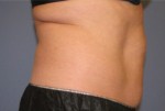 Liposonix® Before and after photo