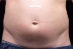 Liposonix® Before and after photo