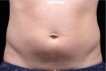 Liposonix® Before and after photo