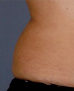 Liposonix® Before and after photo