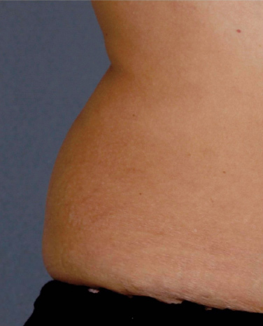 Liposonix® before and after photo