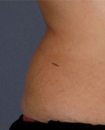 Liposonix® Before and after photo