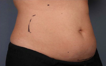 Liposonix® before and after photo