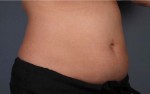 Liposonix® Before and after photo