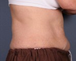 Liposonix® Before and after photo