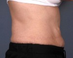 Liposonix® Before and after photo