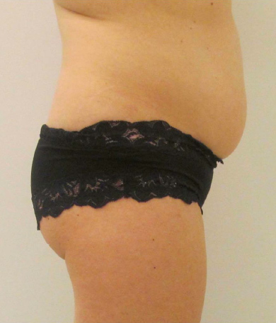 Liposonix® before and after photo