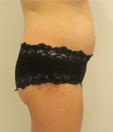 Liposonix® before and after photo