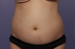 Liposonix® Before and after photo