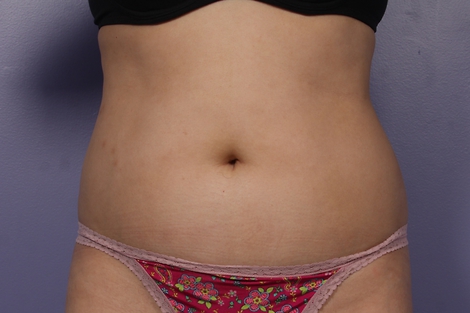 Liposonix® before and after photo