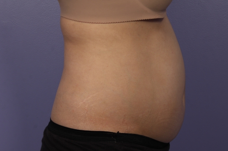 Liposonix® before and after photo