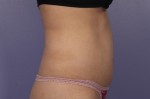 Liposonix® Before and after photo