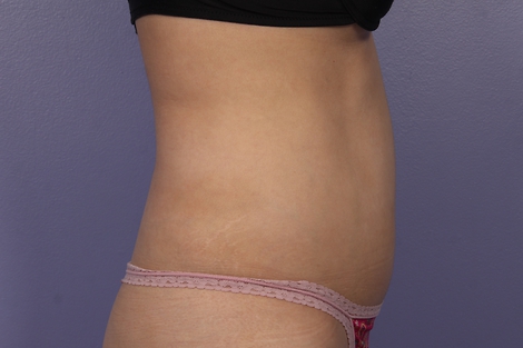 Liposonix® before and after photo