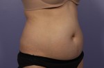 Liposonix® Before and after photo