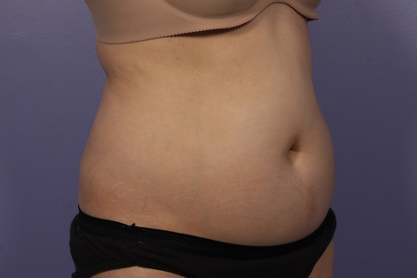 Liposonix® before and after photo