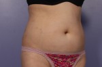 Liposonix® Before and after photo