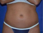 Liposonix® Before and after photo