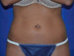 Liposonix® Before and after photo