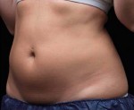 Liposonix® Before and after photo